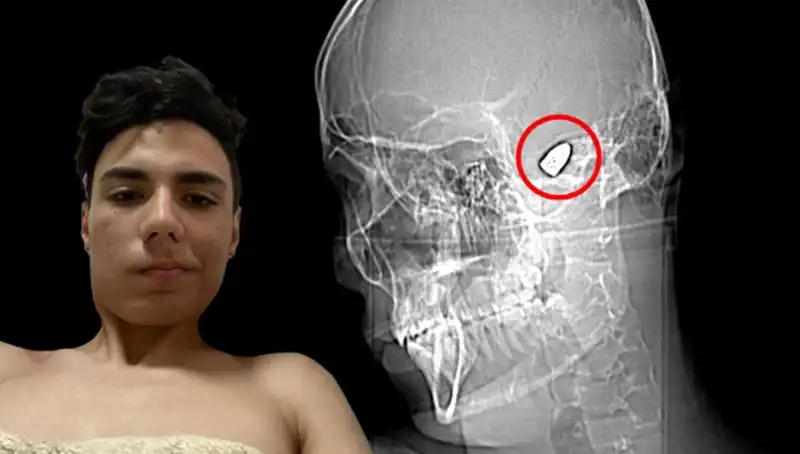 Kafasında Patlayıcı Bomba Taşıyan Adamın Hikayesi İnanılmaz Detaylarla Dolu